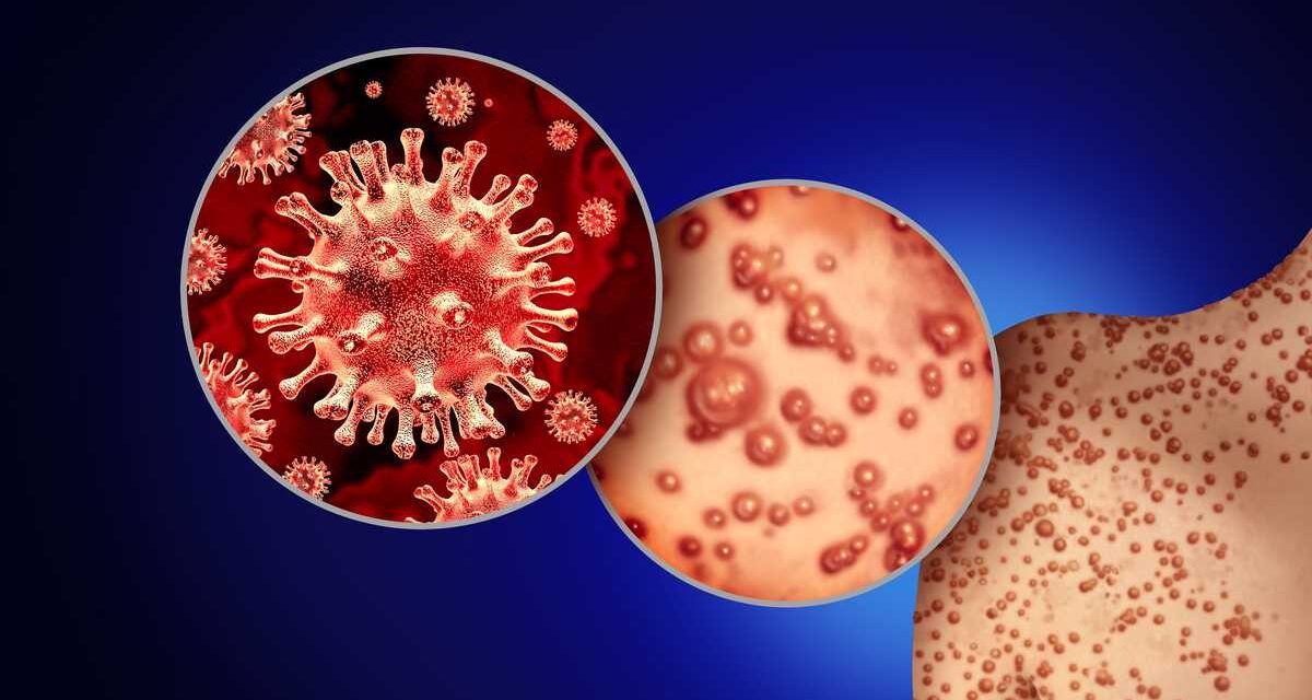 Coatzintla: Viruela Símica