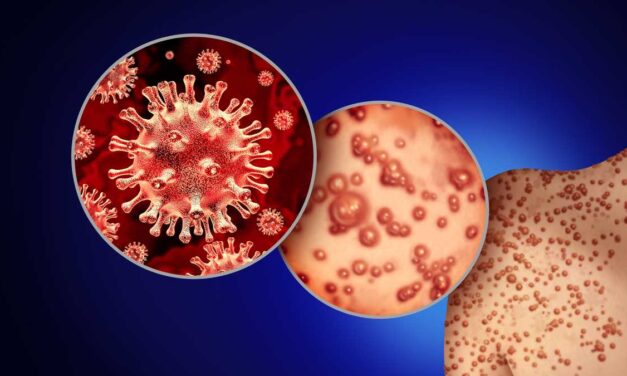 Coatzintla: Viruela Símica