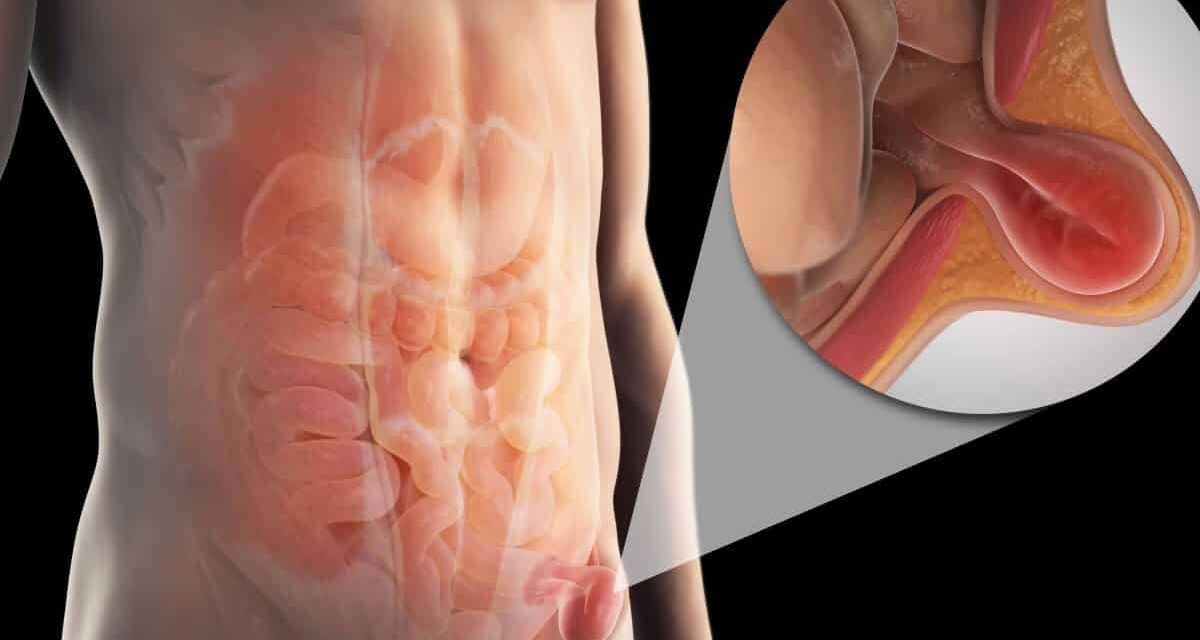 Mecatlán: Cirugías de Hernia y Vesícula